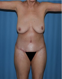 Body Contouring After Photo by Siamak Agha, MD PhD FACS; Newport Beach, CA - Case 44007