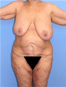 Body Contouring Before Photo by Siamak Agha, MD PhD FACS; Newport Beach, CA - Case 44011