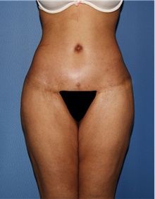 Body Contouring After Photo by Siamak Agha, MD PhD FACS; Newport Beach, CA - Case 44039