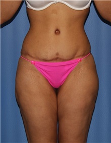 Body Contouring Before Photo by Siamak Agha, MD PhD FACS; Newport Beach, CA - Case 44039