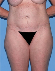Body Contouring Before Photo by Siamak Agha, MD PhD FACS; Newport Beach, CA - Case 44046