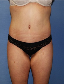 Body Contouring After Photo by Siamak Agha, MD PhD FACS; Newport Beach, CA - Case 44050