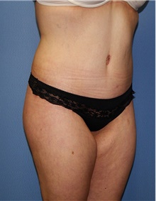 Body Contouring After Photo by Siamak Agha, MD PhD FACS; Newport Beach, CA - Case 44050