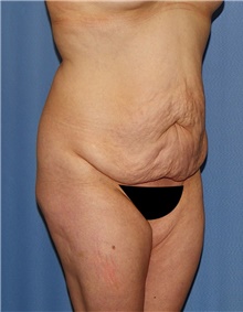 Body Contouring Before Photo by Siamak Agha, MD PhD FACS; Newport Beach, CA - Case 44050