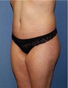 Body Contouring After Photo by Siamak Agha, MD PhD FACS; Newport Beach, CA - Case 44050