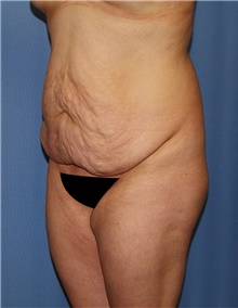 Body Contouring Before Photo by Siamak Agha, MD PhD FACS; Newport Beach, CA - Case 44050