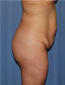 Body Contouring Before Photo by Siamak Agha, MD PhD FACS; Newport Beach, CA - Case 44050
