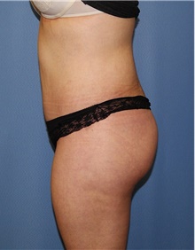 Body Contouring After Photo by Siamak Agha, MD PhD FACS; Newport Beach, CA - Case 44050