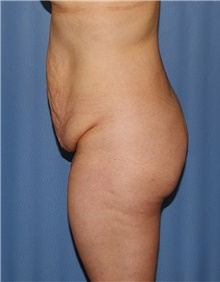 Body Contouring Before Photo by Siamak Agha, MD PhD FACS; Newport Beach, CA - Case 44050