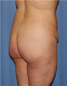 Body Contouring Before Photo by Siamak Agha, MD PhD FACS; Newport Beach, CA - Case 44050