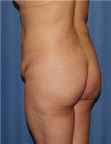 Body Contouring Before Photo by Siamak Agha, MD PhD FACS; Newport Beach, CA - Case 44050