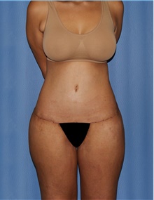 Body Contouring After Photo by Siamak Agha, MD PhD FACS; Newport Beach, CA - Case 44051