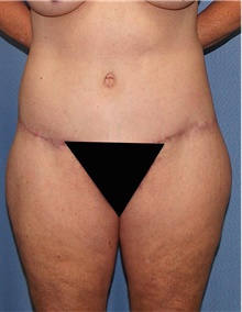 Body Contouring After Photo by Siamak Agha, MD PhD FACS; Newport Beach, CA - Case 44053