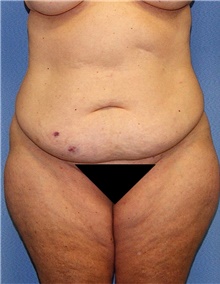 Body Contouring Before Photo by Siamak Agha, MD PhD FACS; Newport Beach, CA - Case 44053