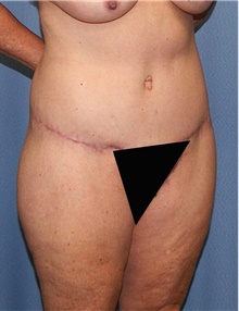 Body Contouring After Photo by Siamak Agha, MD PhD FACS; Newport Beach, CA - Case 44053