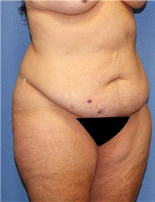 Body Contouring Before Photo by Siamak Agha, MD PhD FACS; Newport Beach, CA - Case 44053