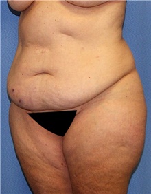 Body Contouring Before Photo by Siamak Agha, MD PhD FACS; Newport Beach, CA - Case 44053