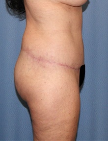 Body Contouring After Photo by Siamak Agha, MD PhD FACS; Newport Beach, CA - Case 44053