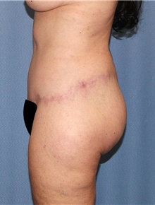 Body Contouring After Photo by Siamak Agha, MD PhD FACS; Newport Beach, CA - Case 44053