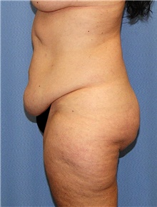 Body Contouring Before Photo by Siamak Agha, MD PhD FACS; Newport Beach, CA - Case 44053