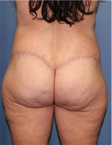Body Contouring After Photo by Siamak Agha, MD PhD FACS; Newport Beach, CA - Case 44053