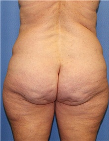 Body Contouring Before Photo by Siamak Agha, MD PhD FACS; Newport Beach, CA - Case 44053