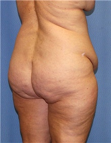 Body Contouring Before Photo by Siamak Agha, MD PhD FACS; Newport Beach, CA - Case 44053
