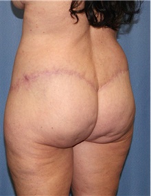 Body Contouring After Photo by Siamak Agha, MD PhD FACS; Newport Beach, CA - Case 44053