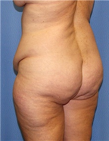 Body Contouring Before Photo by Siamak Agha, MD PhD FACS; Newport Beach, CA - Case 44053