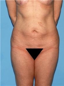 Body Contouring Before Photo by Siamak Agha, MD PhD FACS; Newport Beach, CA - Case 44058