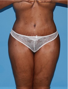 Body Contouring After Photo by Siamak Agha, MD PhD FACS; Newport Beach, CA - Case 44086