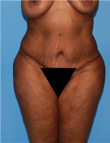 Body Contouring Before Photo by Siamak Agha, MD PhD FACS; Newport Beach, CA - Case 44086