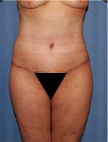 Body Contouring After Photo by Siamak Agha, MD PhD FACS; Newport Beach, CA - Case 44097