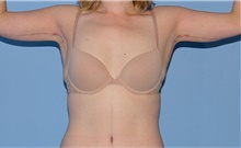 Arm Lift After Photo by Siamak Agha, MD PhD FACS; Newport Beach, CA - Case 44114