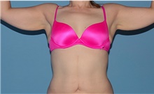 Arm Lift Before Photo by Siamak Agha, MD PhD FACS; Newport Beach, CA - Case 44114