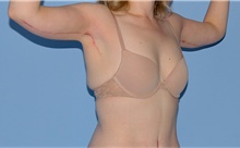 Arm Lift After Photo by Siamak Agha, MD PhD FACS; Newport Beach, CA - Case 44114