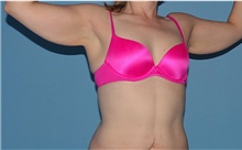 Arm Lift Before Photo by Siamak Agha, MD PhD FACS; Newport Beach, CA - Case 44114