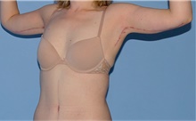 Arm Lift After Photo by Siamak Agha, MD PhD FACS; Newport Beach, CA - Case 44114