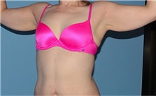 Arm Lift Before Photo by Siamak Agha, MD PhD FACS; Newport Beach, CA - Case 44114