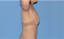 Arm Lift After Photo by Siamak Agha, MD PhD FACS; Newport Beach, CA - Case 44114