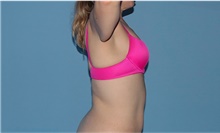 Arm Lift Before Photo by Siamak Agha, MD PhD FACS; Newport Beach, CA - Case 44114