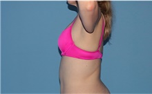 Arm Lift Before Photo by Siamak Agha, MD PhD FACS; Newport Beach, CA - Case 44114