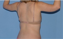 Arm Lift After Photo by Siamak Agha, MD PhD FACS; Newport Beach, CA - Case 44114