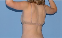 Arm Lift After Photo by Siamak Agha, MD PhD FACS; Newport Beach, CA - Case 44114