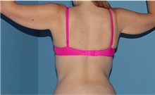 Arm Lift Before Photo by Siamak Agha, MD PhD FACS; Newport Beach, CA - Case 44114