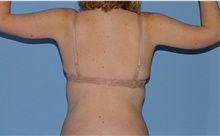 Arm Lift After Photo by Siamak Agha, MD PhD FACS; Newport Beach, CA - Case 44114