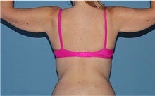 Arm Lift Before Photo by Siamak Agha, MD PhD FACS; Newport Beach, CA - Case 44114