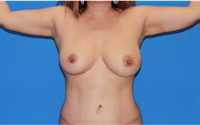 Arm Lift After Photo by Siamak Agha, MD PhD FACS; Newport Beach, CA - Case 44115
