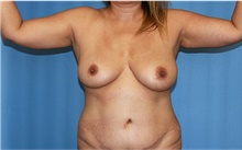 Arm Lift Before Photo by Siamak Agha, MD PhD FACS; Newport Beach, CA - Case 44115