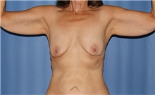 Arm Lift Before Photo by Siamak Agha, MD PhD FACS; Newport Beach, CA - Case 44116